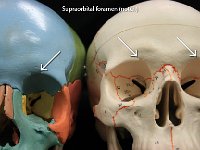 02 Supraorbital foramen-01 : eye socket, notch, cranial bone, skull