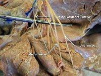 12 Musculocuteous-ulnar-media-nerve-01 : musculocutaneous nerve, ulnar nerve, median nerve, cat spinal nerve plexus