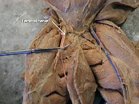 14 Sciatic-Fibular-Tibial Nerve : sciatic nerve, tibial nerve, fibular nerve, cat spinal nerve plexus