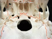 14 Stylomastoid foramen-01 : stylomastoid Foramen, temporal, cranial bone, skull