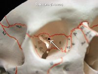 18 Optic Canal 2 : optic canal, cranial bone, skull