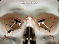 19 Superior Orbital fissure : superior orbital fissure, sphenoid bone, cranial bone, skull