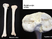 24 Medial condyle of tibia : tibia, medial, medial condyle of femur, lower limb, medial condyle of tibia