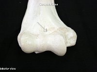 25 Coronoid fossa : coronoid fossa, humerus, elbow joint, upper limb