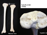 24 Medial condyle of tibia : lateral condyle of tibia, lateral, lateral femoral condyle, lower limb