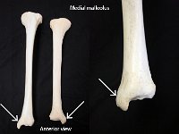 27 Medial malleolus : medial malleolus, ankle joint, tibia, lower limb