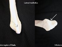 30 Lateral malleolus : lateral malleolus, fibula, distal, lower limb