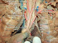 30 right-left common arteries-right-left subclavian arteries-brachiocephalic artery : right common carotid artery, left common carotid artery, right subclavian artery, left subclavian artery, brachiocephalic artery