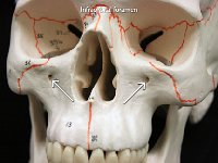 35 Infraorbital foramen : maxillary bone, hole, facial bone, skull, infraorbital foramen