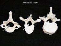 44 Body of vertebra : vertebral foramen, hole, vertebrae, dorsal