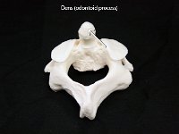 53 Dens (odontoid process)-01 : dens, axis, vertebrae, dorsal, odontoid process