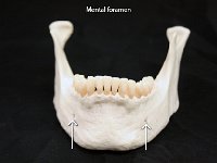 38 Body of mandible : mandible, holes, facial bone, skull, mental foramen