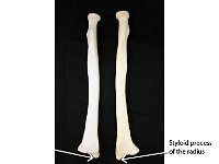 32 head of radius and radial tuberosity : styloid process of radius, distal, carpal bones, upper limb