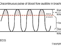 Blood Pressure Cycle  electrocardiogram, ECG, systolic pressure, pulse, diastolic pressure, pressure, mm of mercury, blood flow, bractial artery : electrocardiogram, ECG, systolic pressure, pulse, diastolic pressure, pressure, mm of mercury, blood flow, bractial artery
